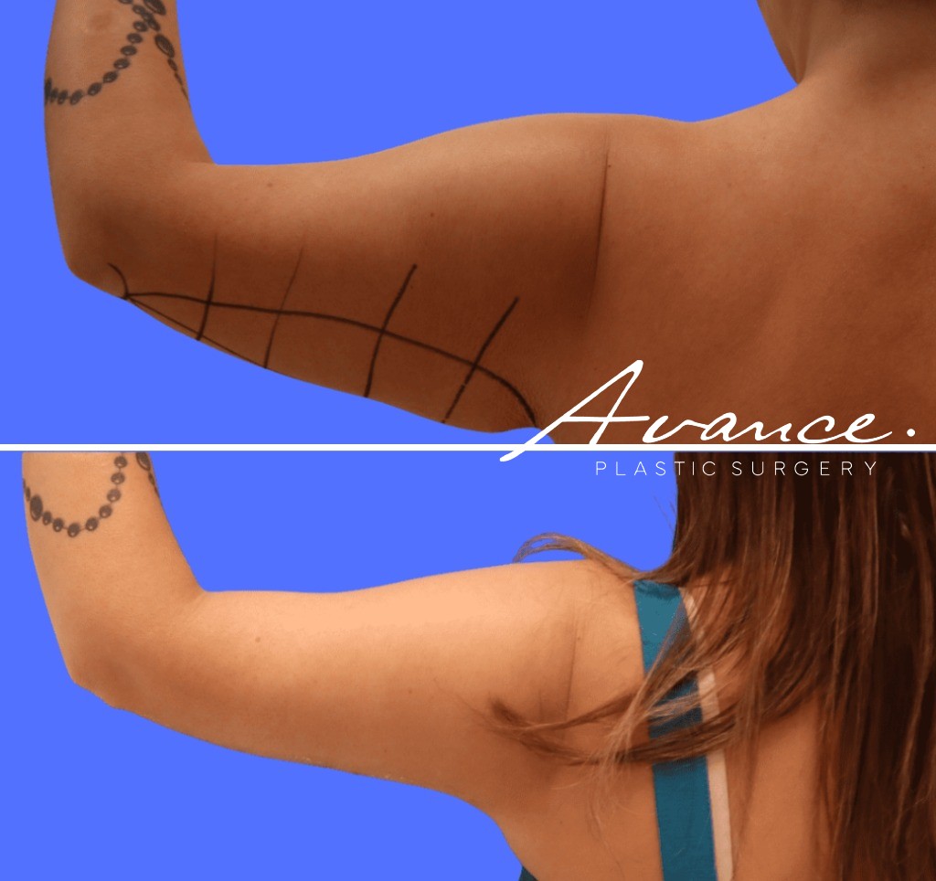Before and After - Brachioplasty (Arm Lift)