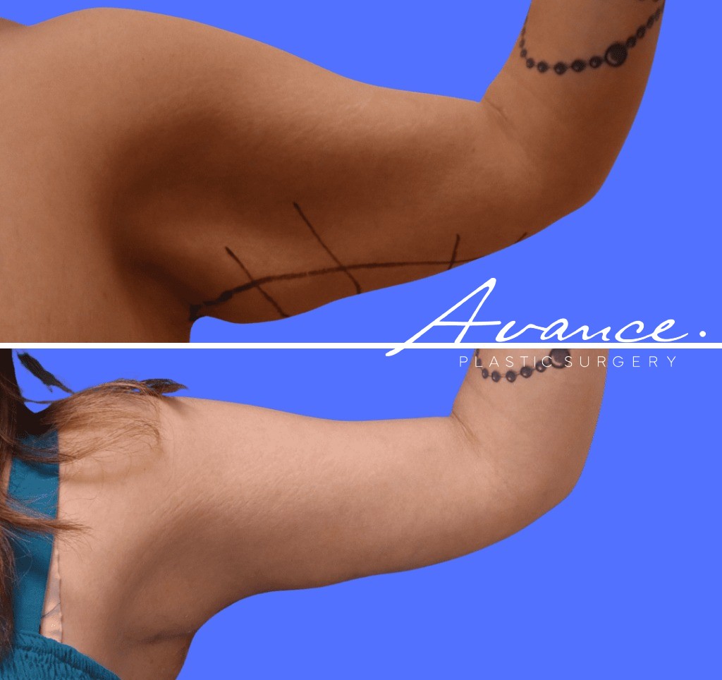 Before and After - Brachioplasty (Arm Lift)