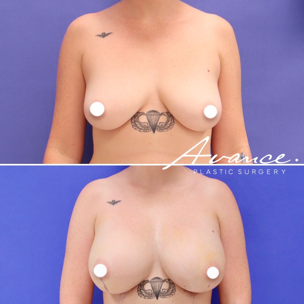 Before and After - Aumento de pecho