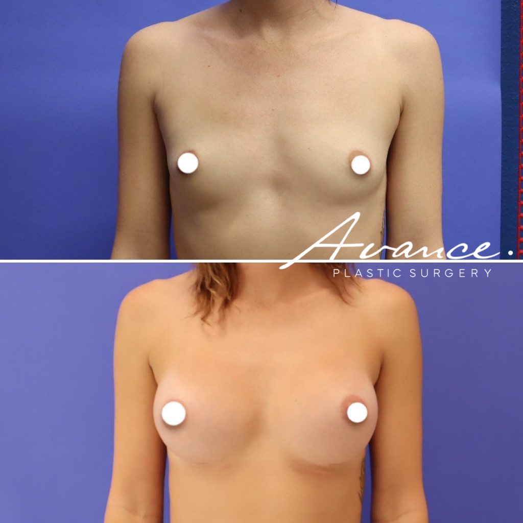 Before and After - Aumento de pecho