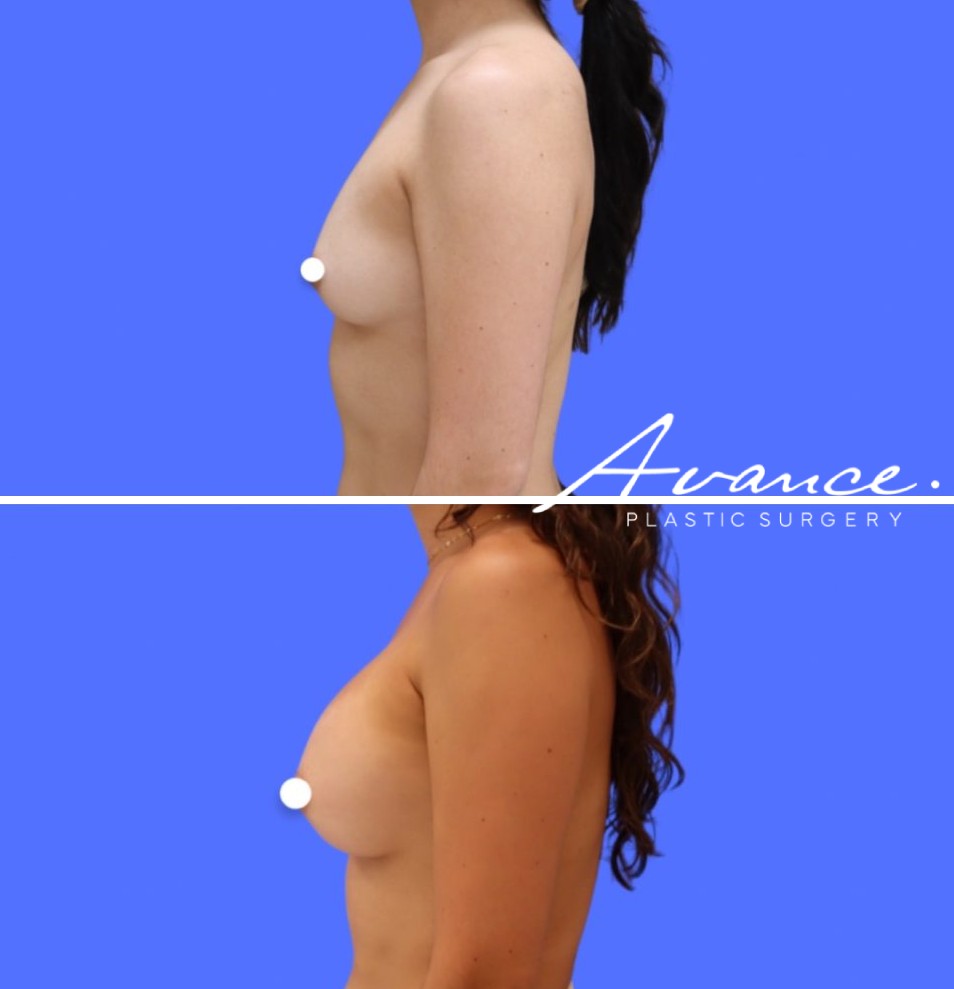 Before and After - Aumento de pecho