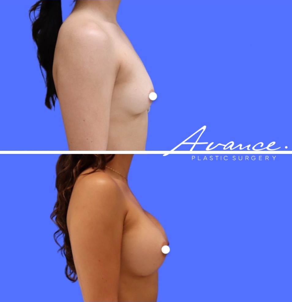 Before and After - Aumento de pecho