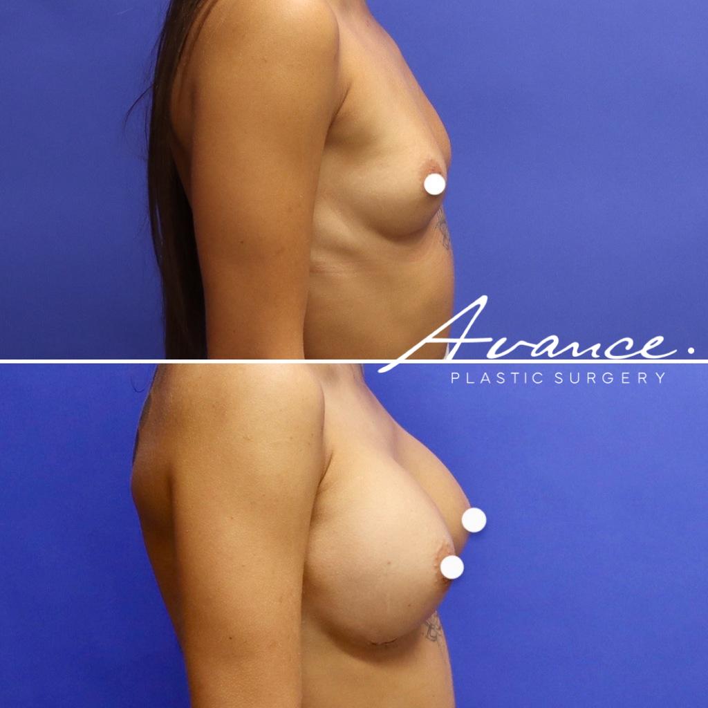 Before and After - Aumento de pecho