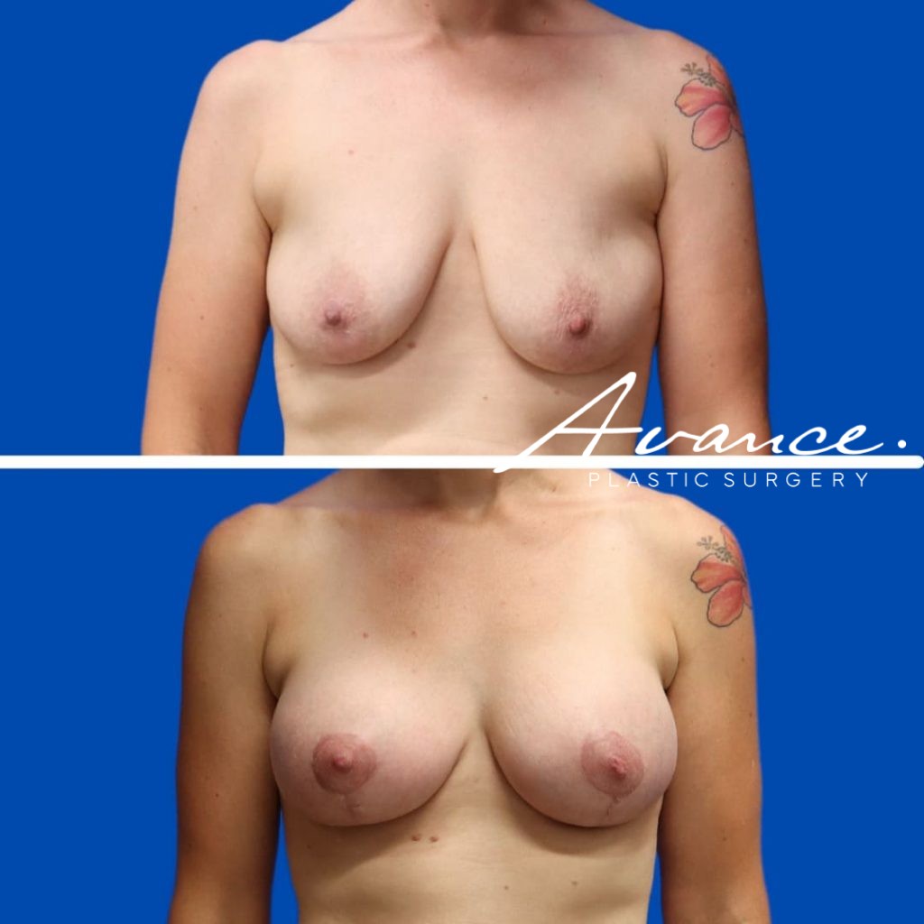 Before and After - Elevación de pecho con implantes (Mastopexia de aumento)