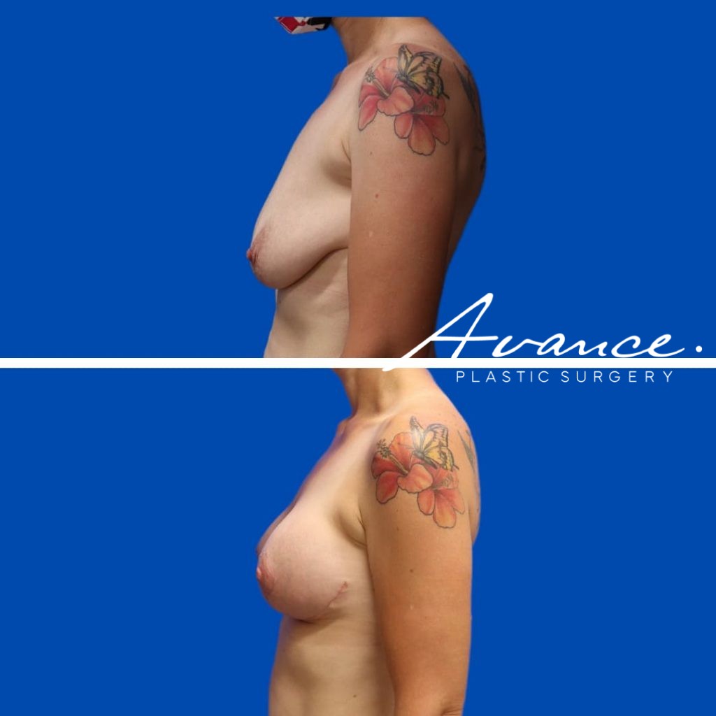 Before and After - Elevación de pecho con implantes (Mastopexia de aumento)