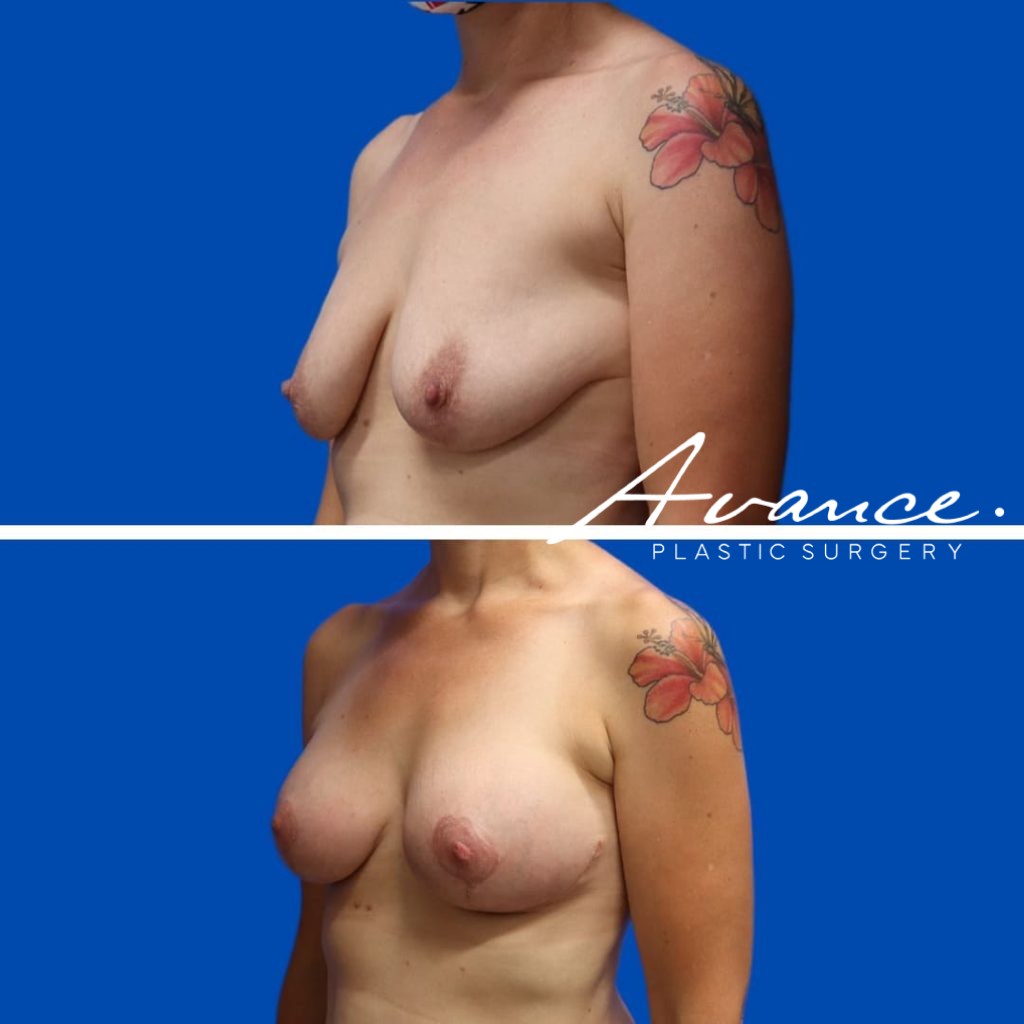 Before and After - Elevación de pecho con implantes (Mastopexia de aumento)