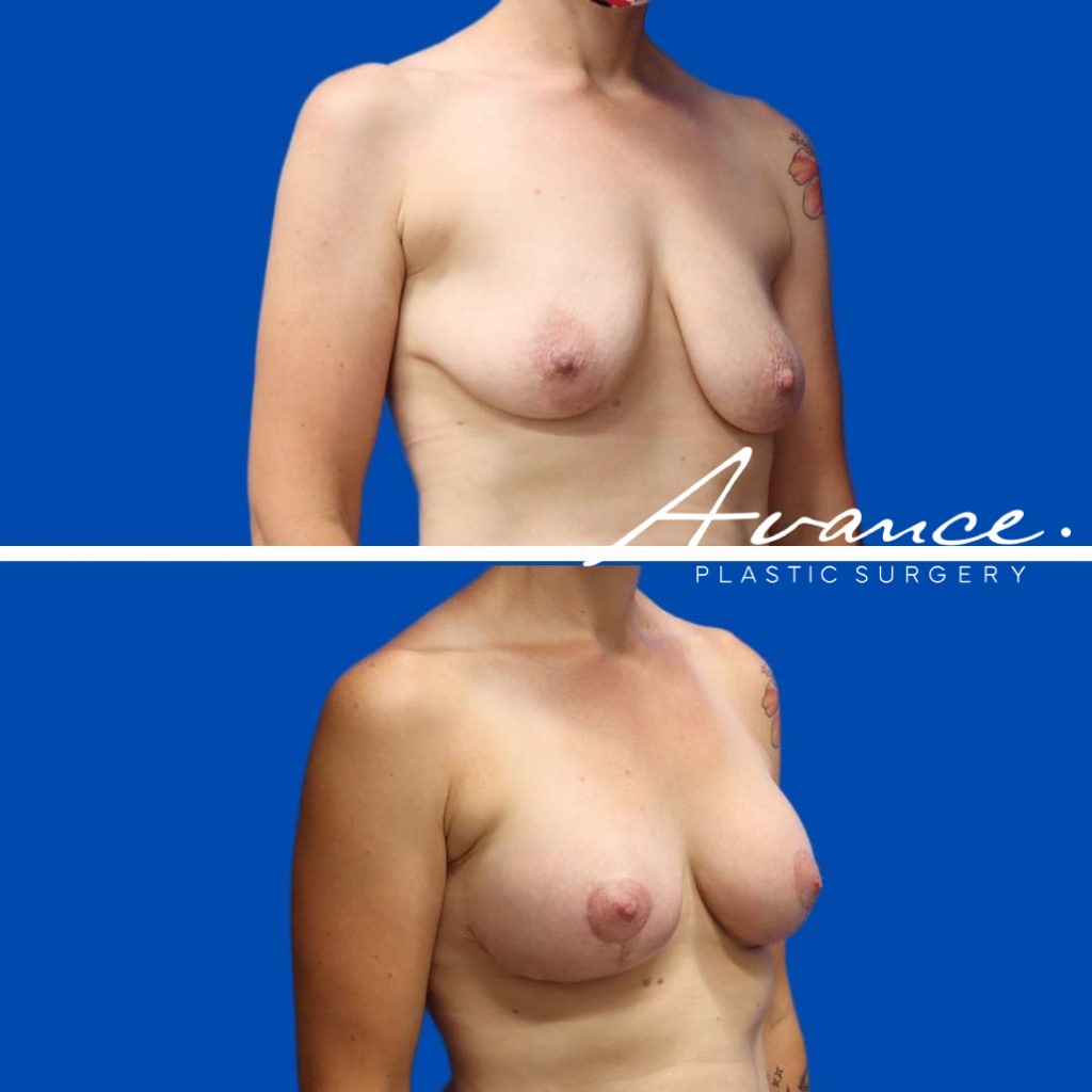 Before and After - Elevación de pecho con implantes (Mastopexia de aumento)