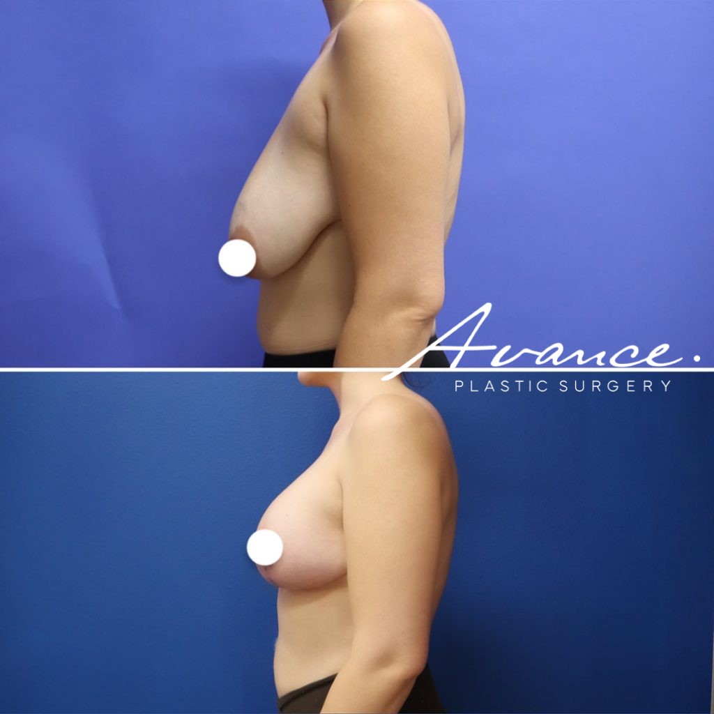 Before and After - Elevación de pecho con implantes (Mastopexia de aumento)