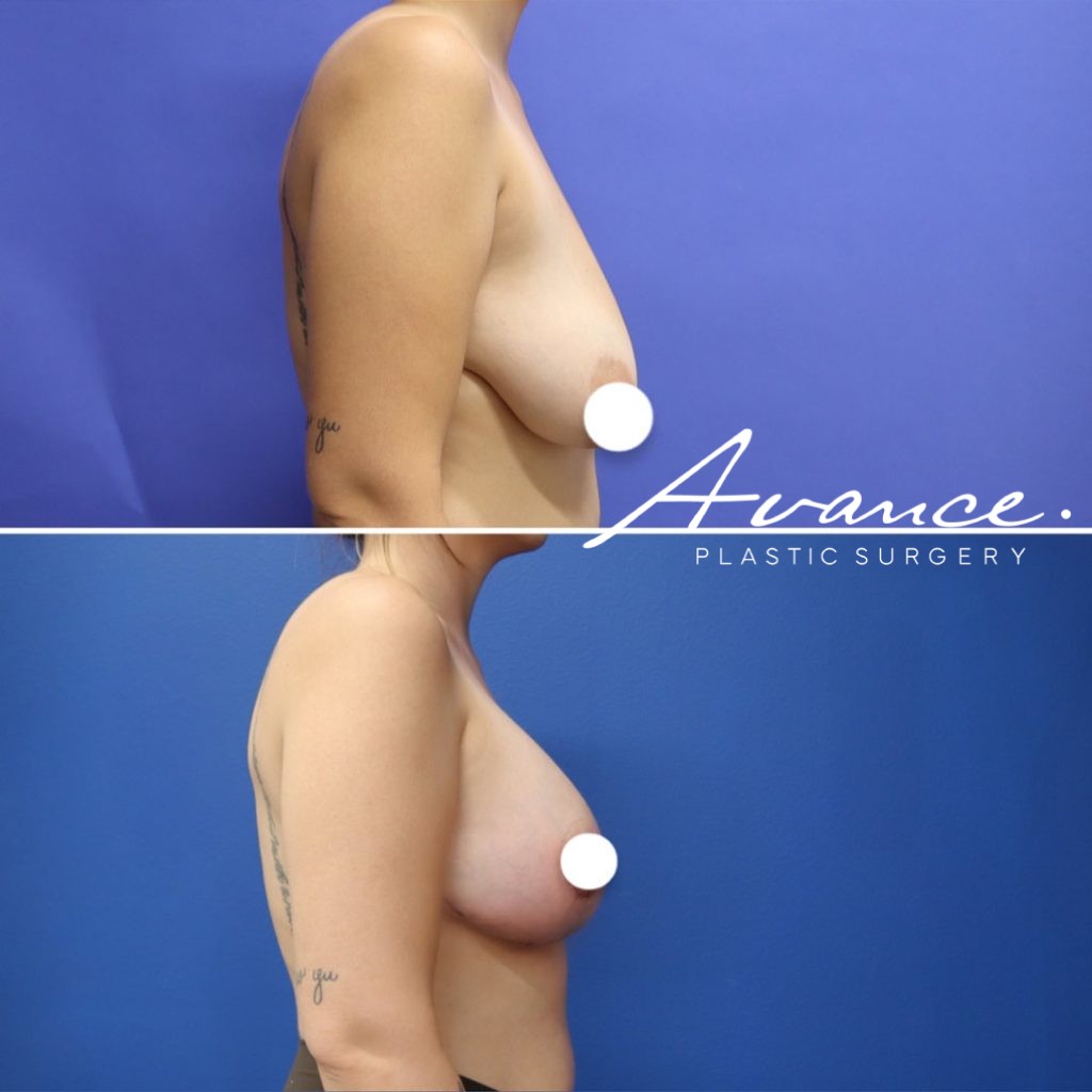 Before and After - Elevación de pecho con implantes (Mastopexia de aumento)