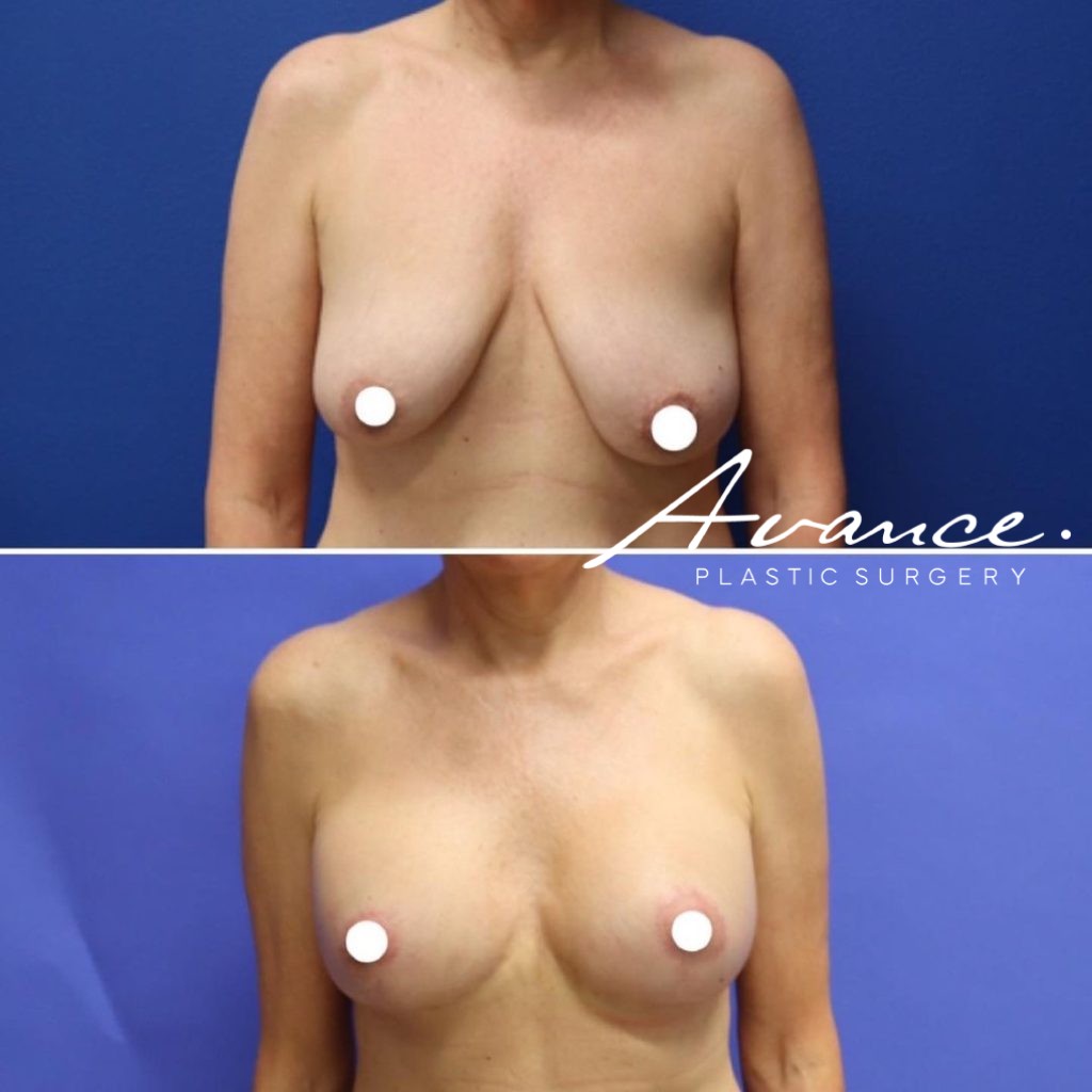 Before and After - Elevación de pecho con implantes (Mastopexia de aumento)