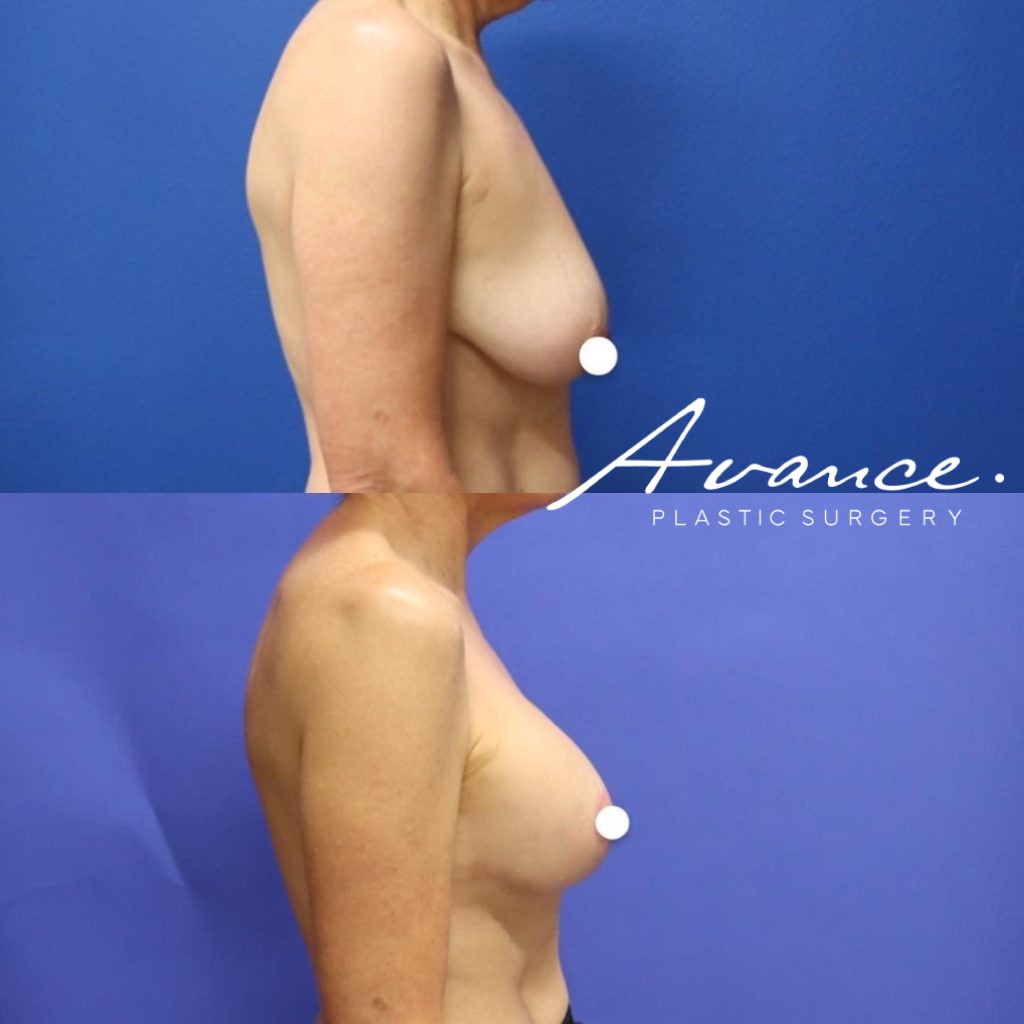 Before and After - Elevación de pecho con implantes (Mastopexia de aumento)