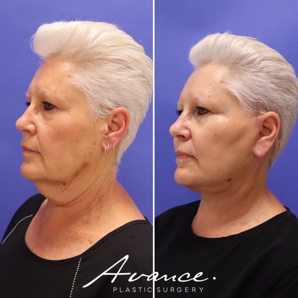Before and After - Facelift/Necklift & Minifacelift/Necklift