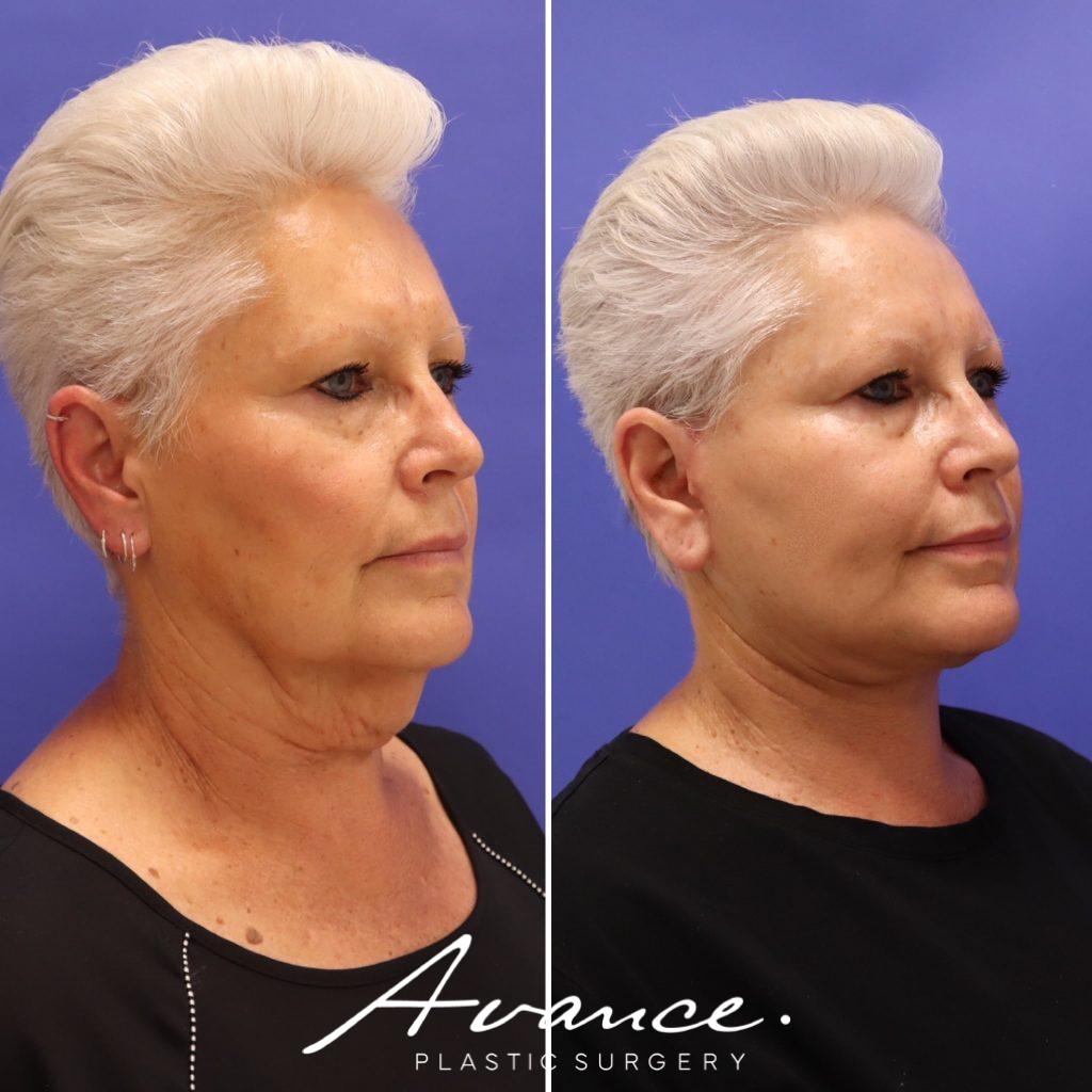 Before and After - Facelift/Necklift & Minifacelift/Necklift
