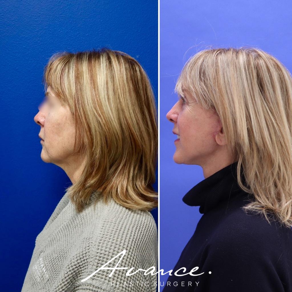 Before and After - Mini Face/Necklift