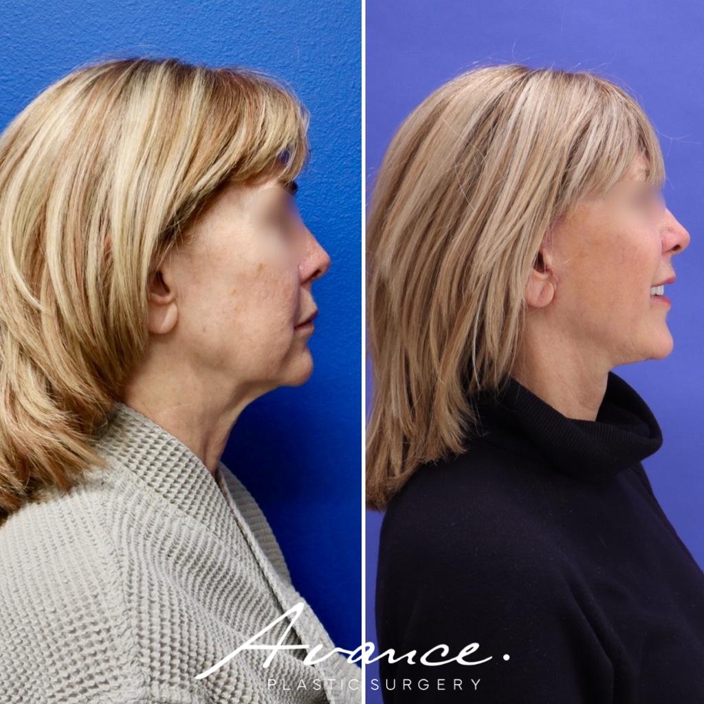 Before and After - Mini Face/Necklift