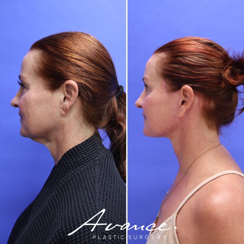 Before and After - Facelift/Necklift & Minifacelift/Necklift