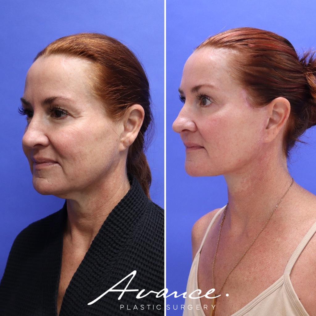 Before and After - Facelift/Necklift & Minifacelift/Necklift