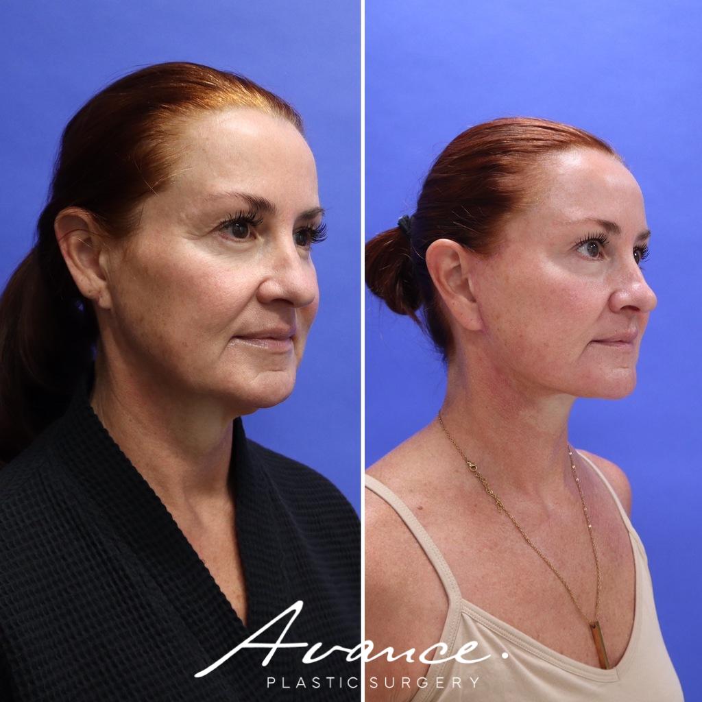 Before and After - Facelift/Necklift & Minifacelift/Necklift