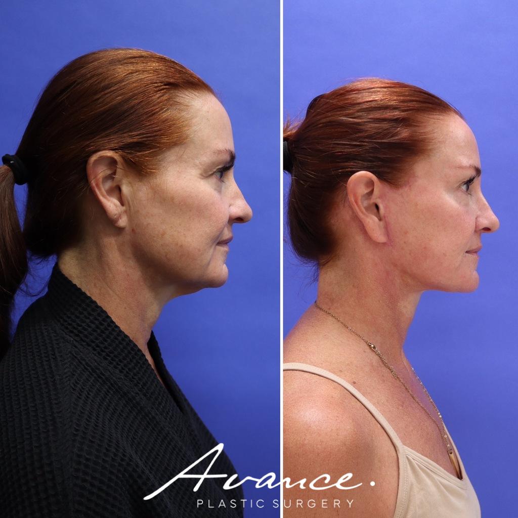 Before and After - Facelift/Necklift & Minifacelift/Necklift