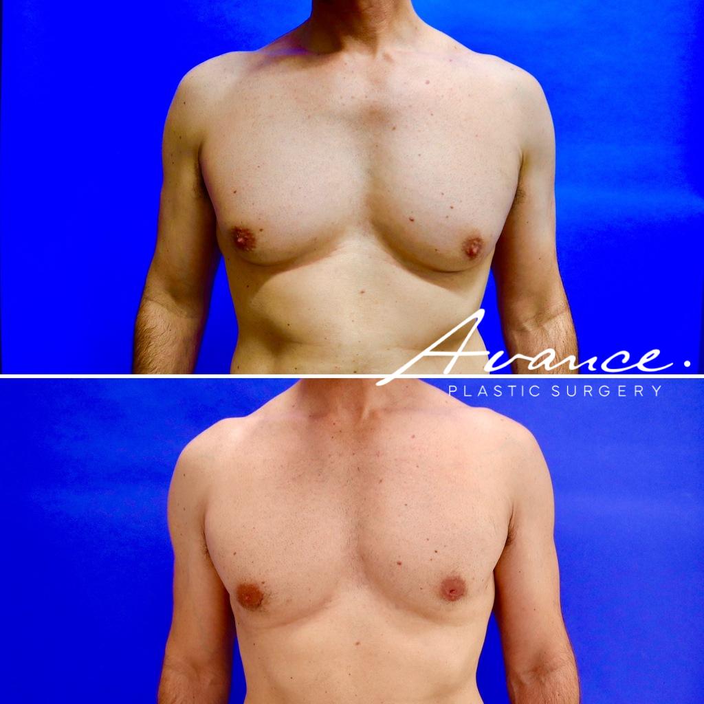 Before and After - Gynecomastia (Male Breast Reduction)