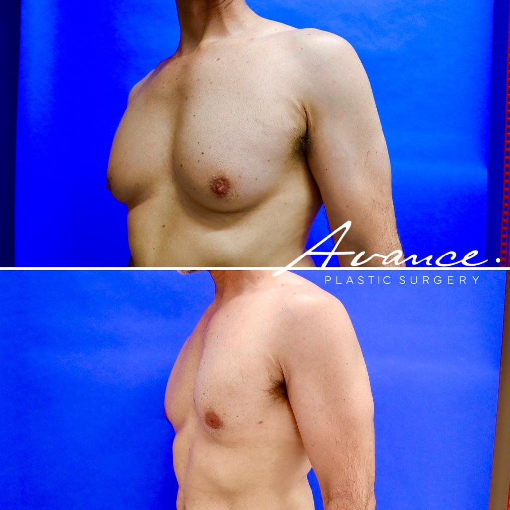 Before and After - Gynecomastia (Male Breast Reduction)