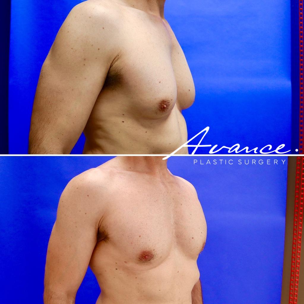 Before and After - Gynecomastia (Male Breast Reduction)