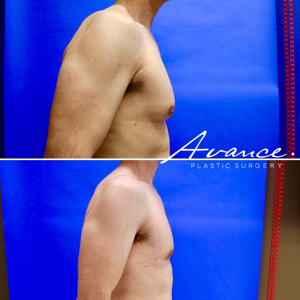 Before and After - Gynecomastia (Male Breast Reduction)