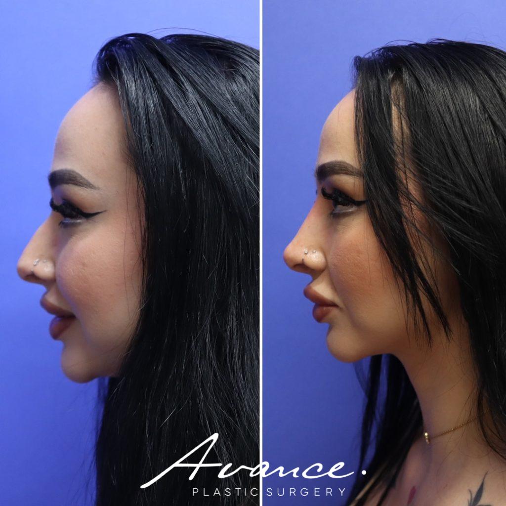 Before and After - Non-Surgical Rhinoplasty