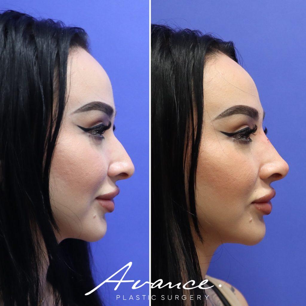 Before and After - Non-Surgical Rhinoplasty