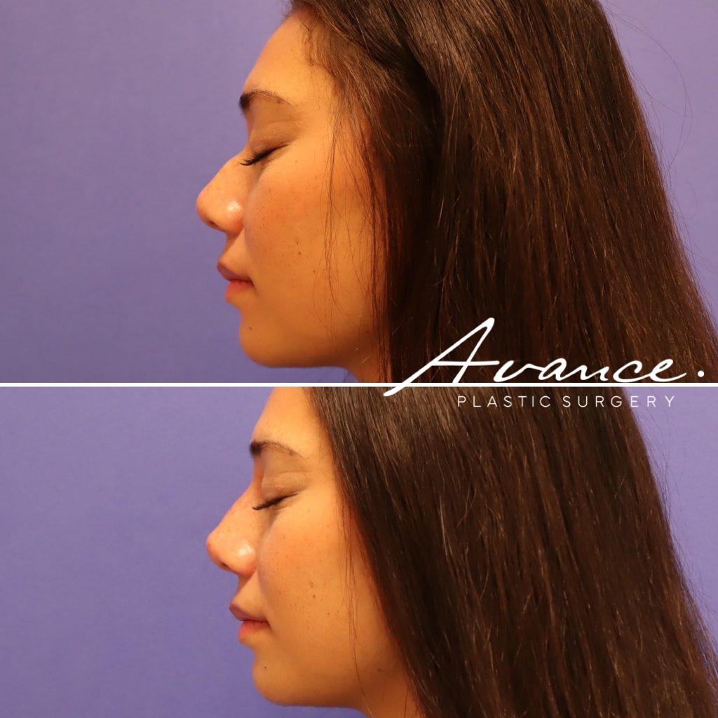 Before and After - Non-Surgical Rhinoplasty