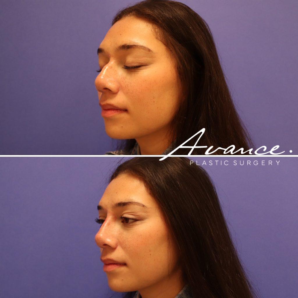 Before and After - Non-Surgical Rhinoplasty