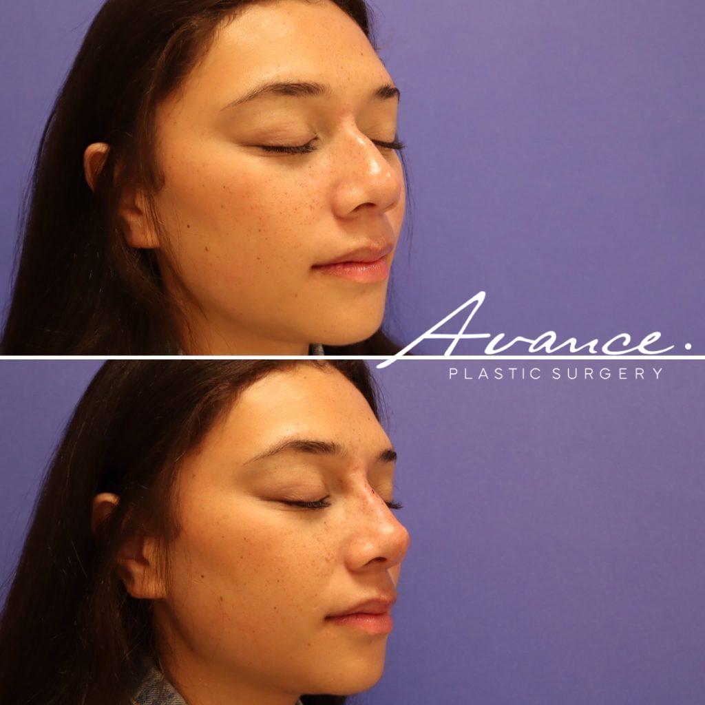Before and After - Non-Surgical Rhinoplasty