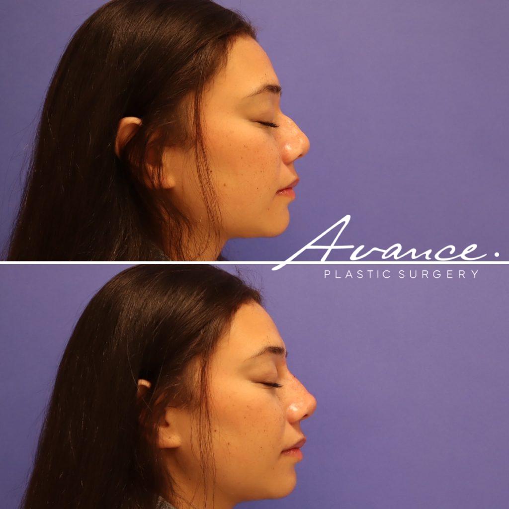 Before and After - Non-Surgical Rhinoplasty