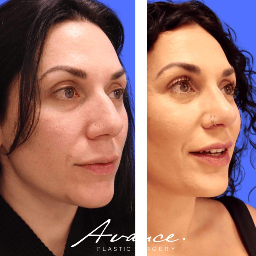 Before and After - Rhinoplasty