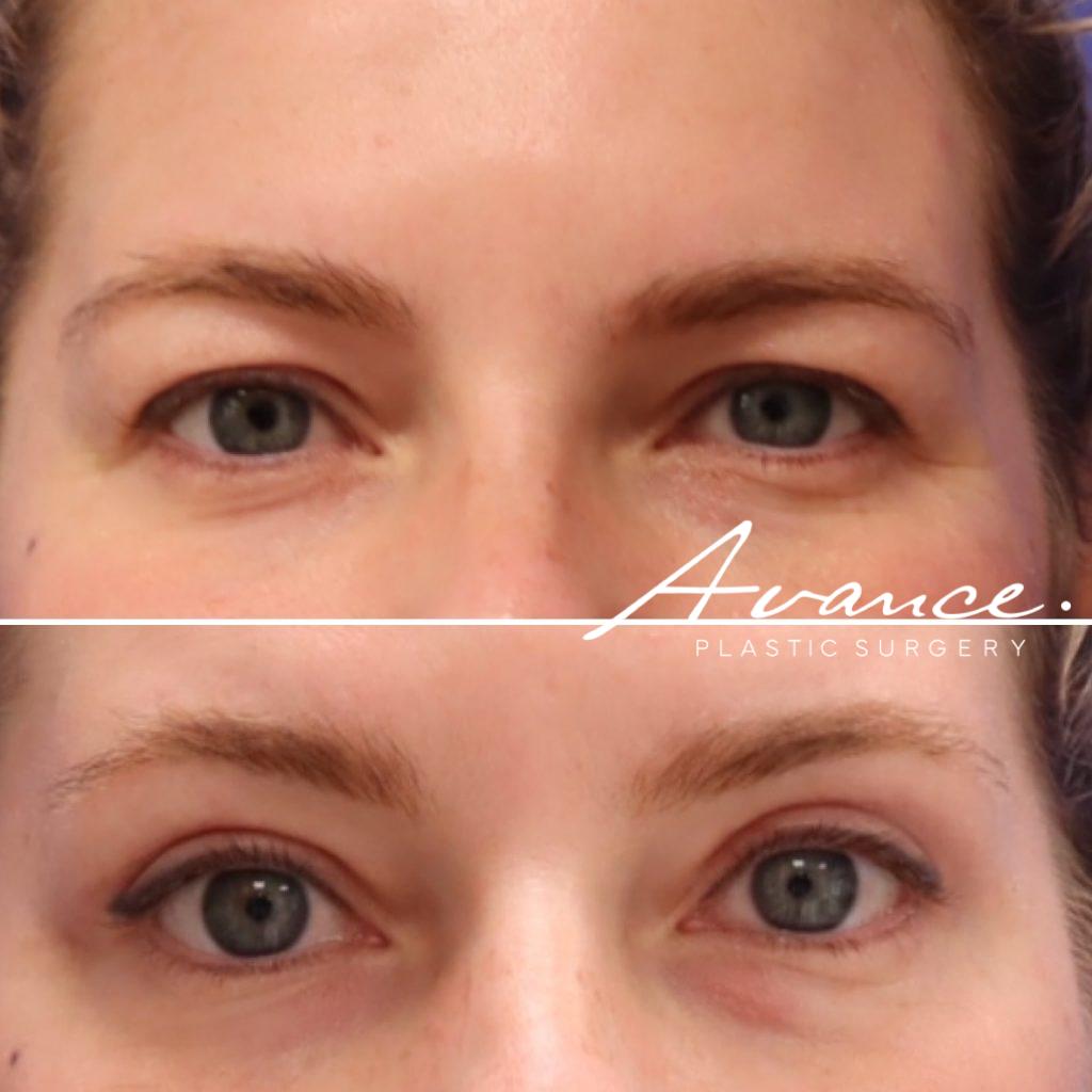 Before and After - Blefaroplastia superior
