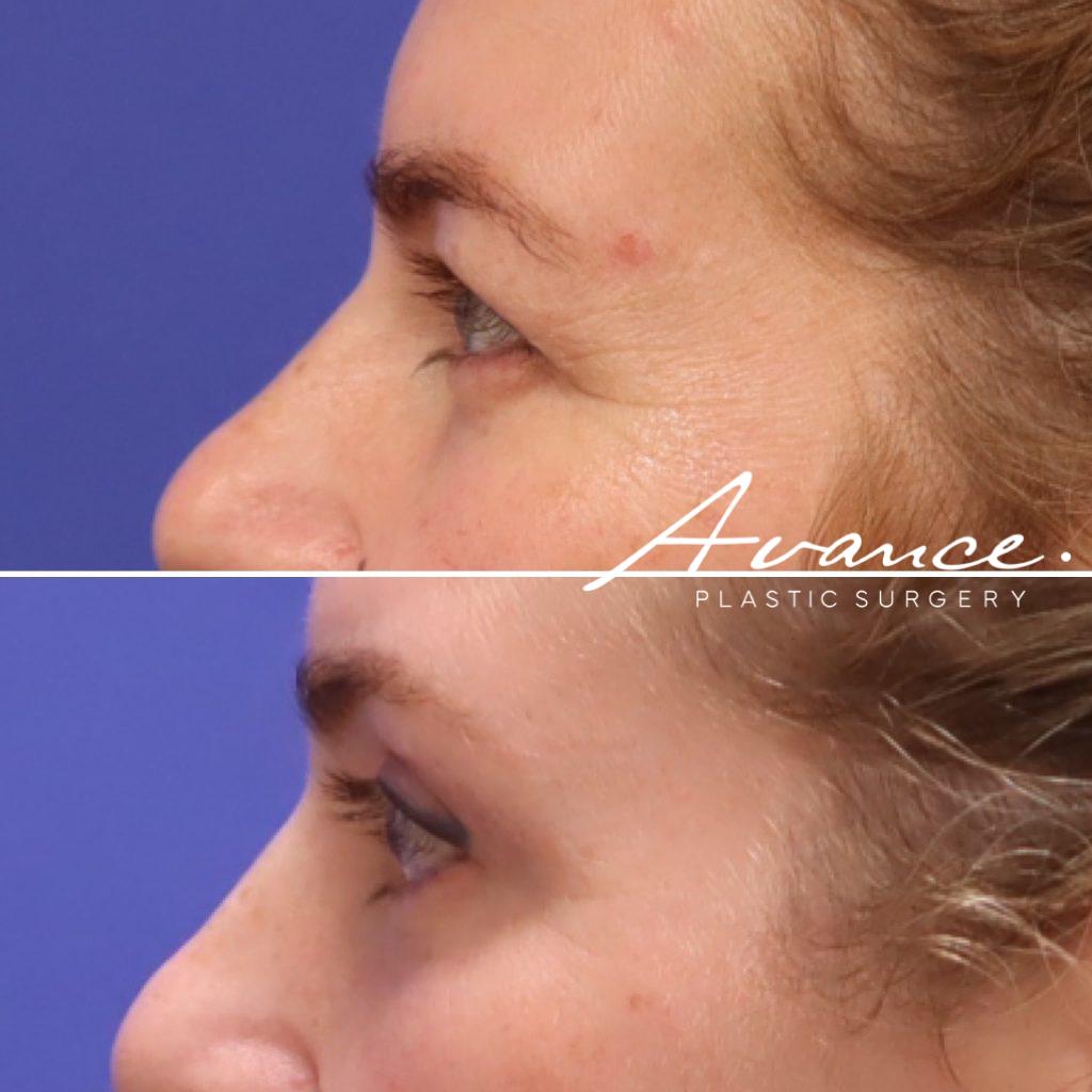 Before and After - Blefaroplastia superior