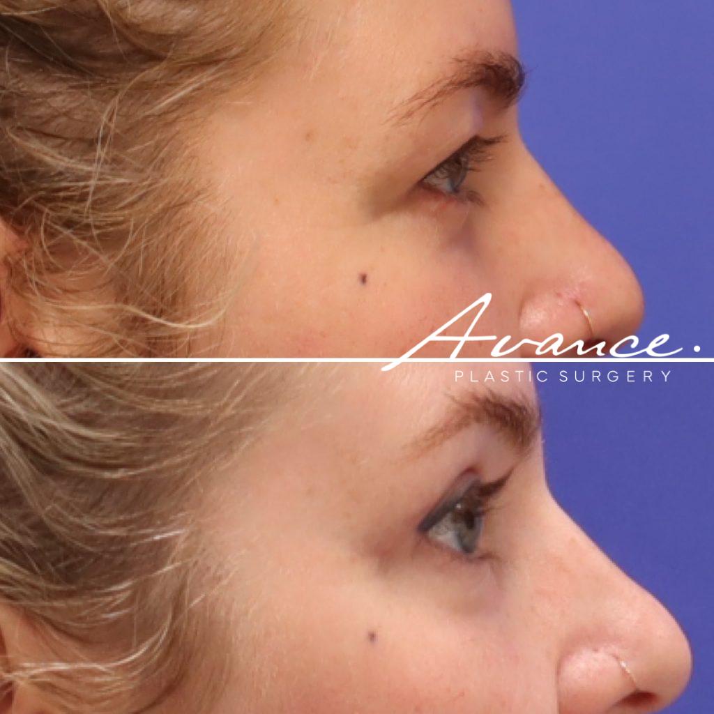 Before and After - Blefaroplastia superior