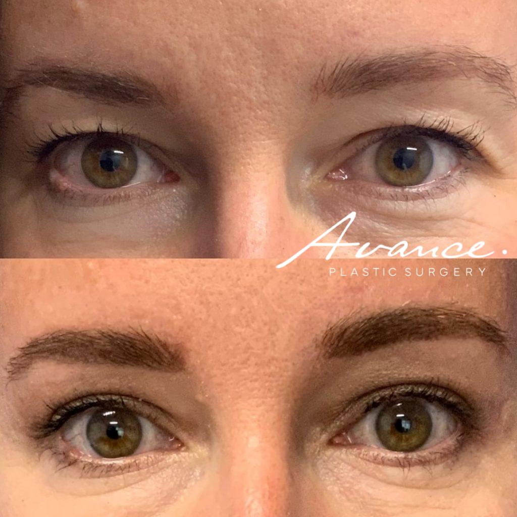 Before and After - Blefaroplastia superior