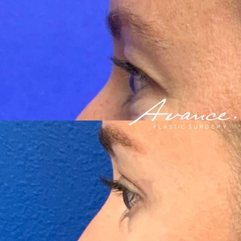 Before and After - Blefaroplastia superior