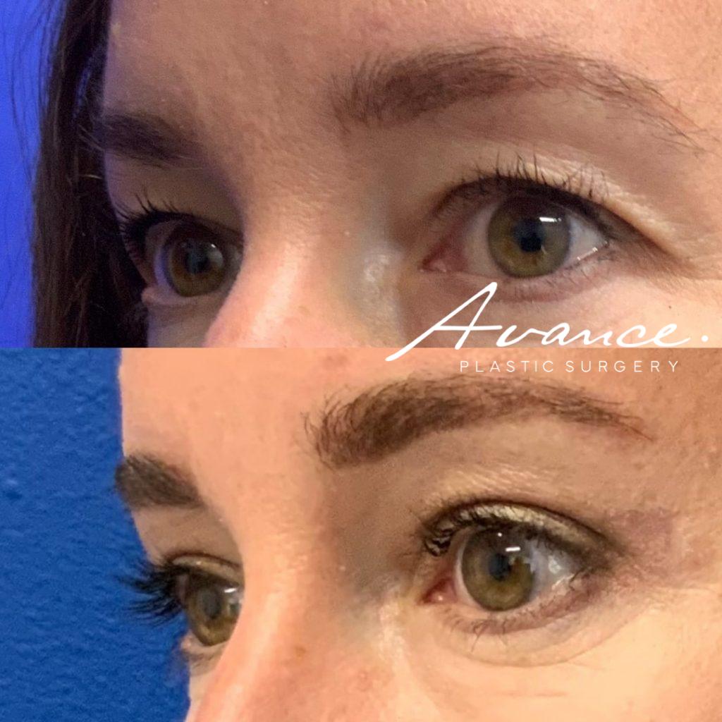Before and After - Blefaroplastia superior