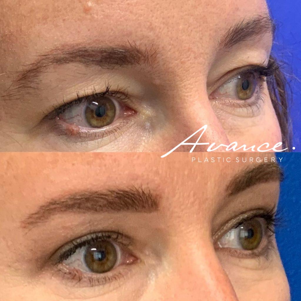 Before and After - Blefaroplastia superior