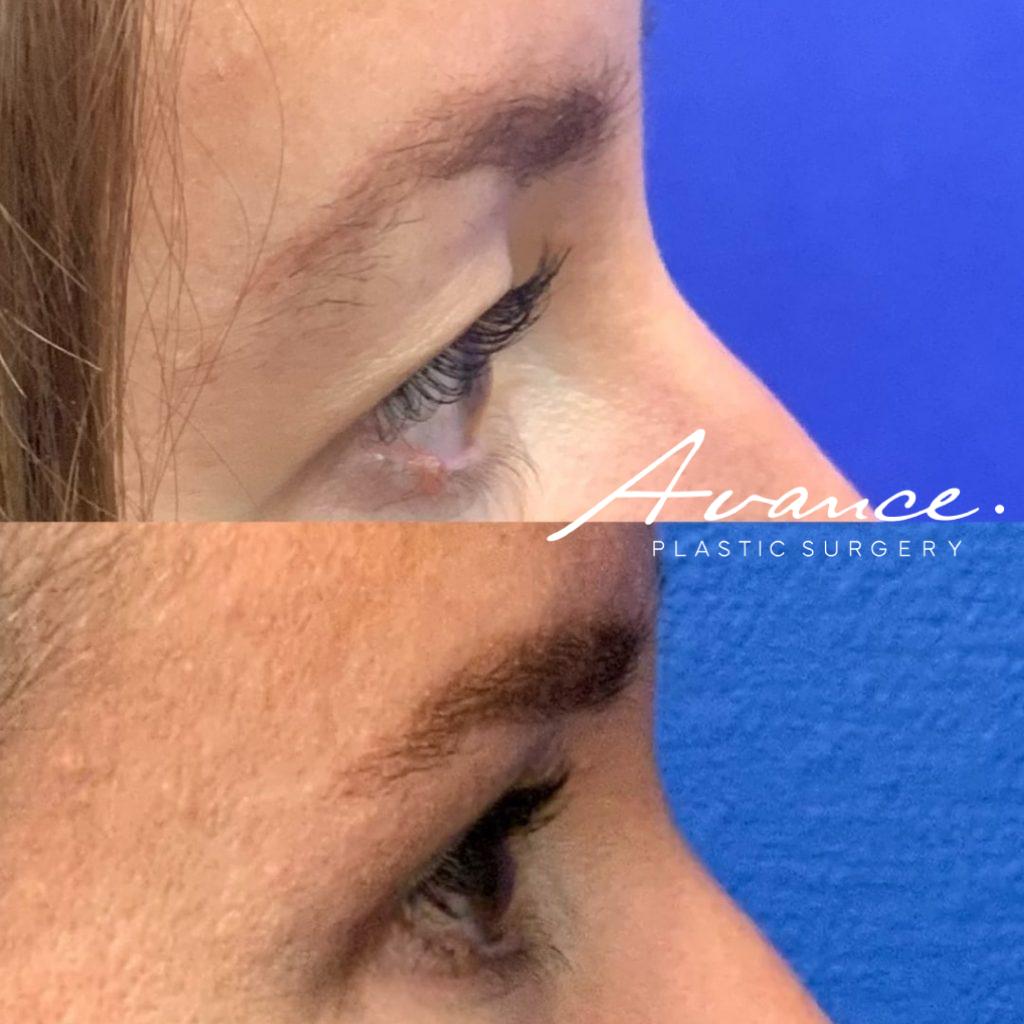 Before and After - Blefaroplastia superior