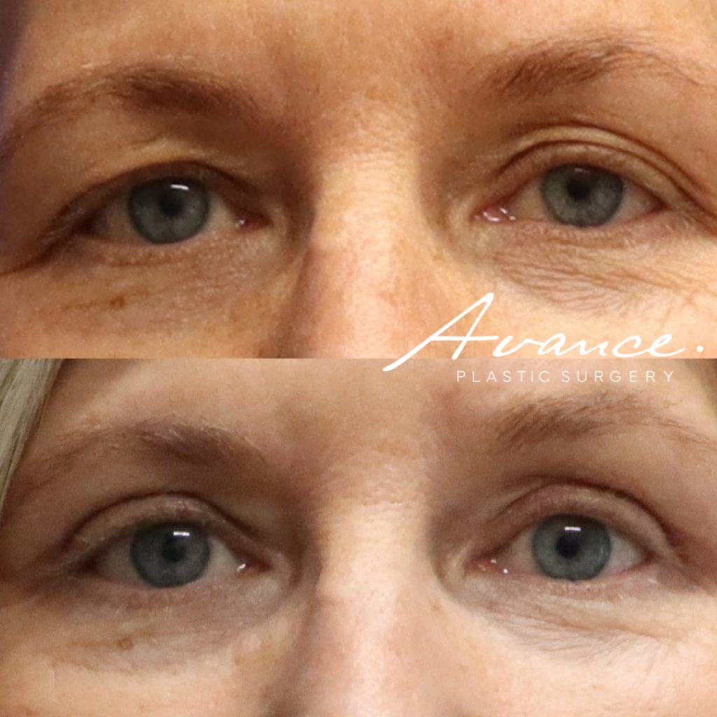 Before and After - Blefaroplastia superior
