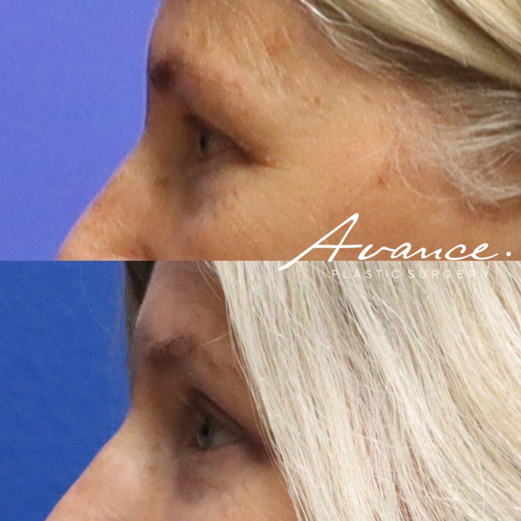 Before and After - Blefaroplastia superior