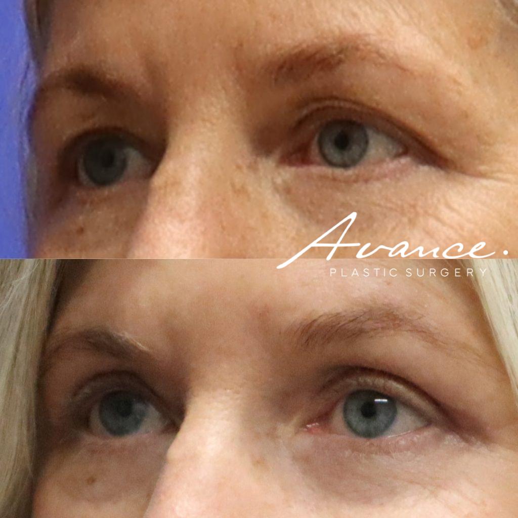 Before and After - Blefaroplastia superior