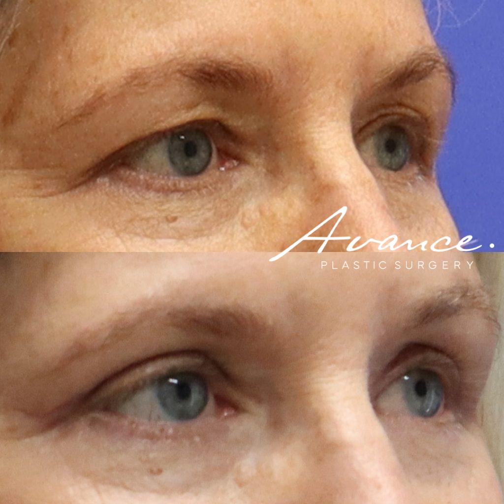 Before and After - Blefaroplastia superior