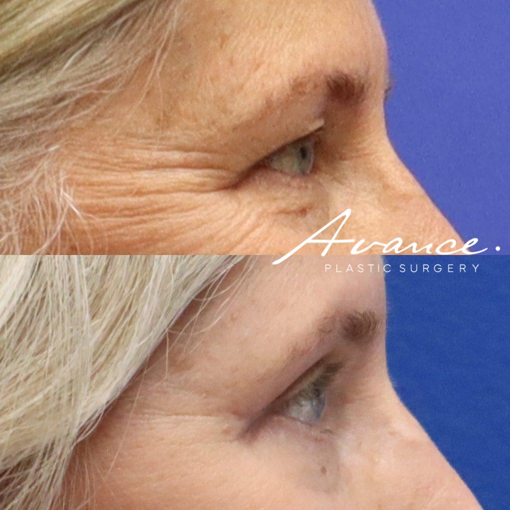 Before and After - Blefaroplastia superior