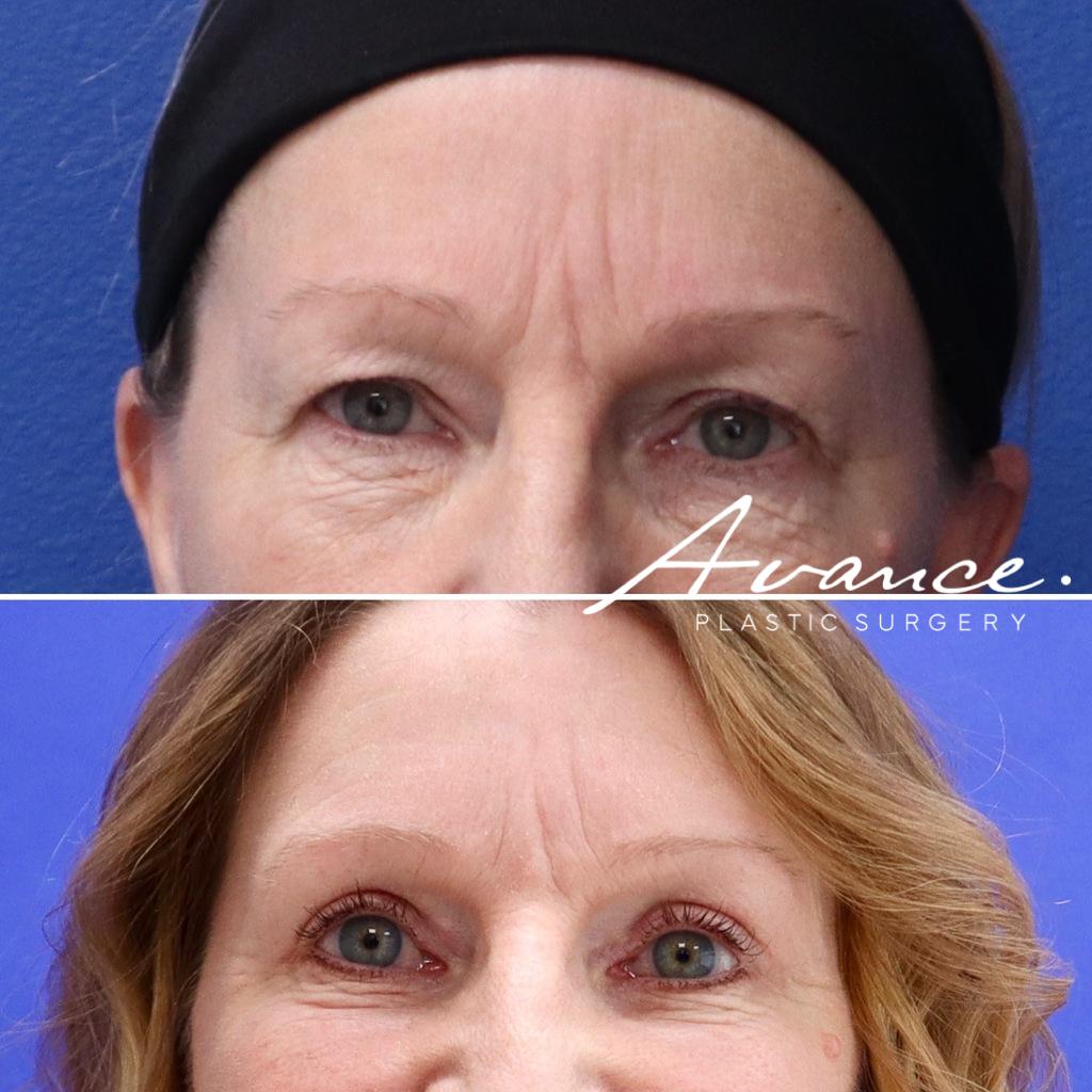 Before and After - Blefaroplastia superior