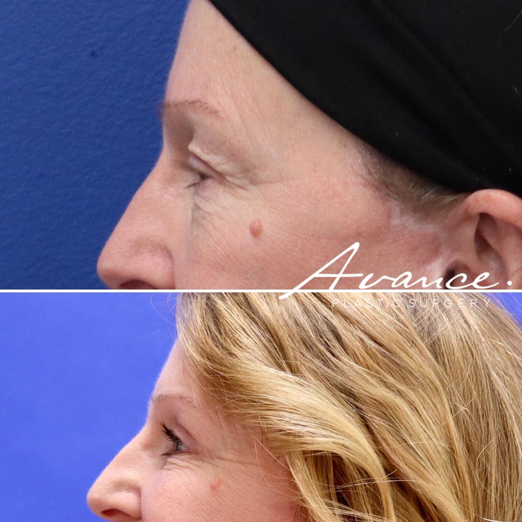 Before and After - Blefaroplastia superior
