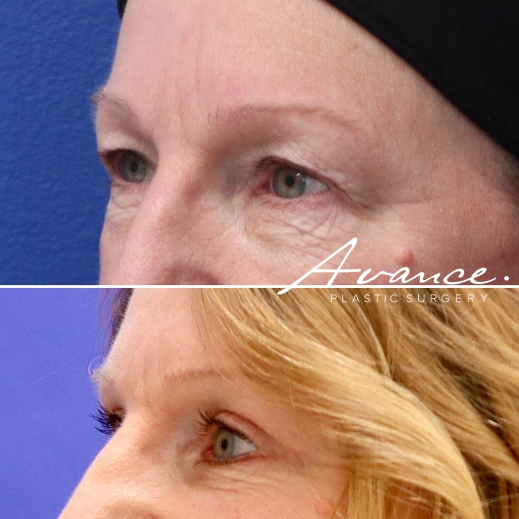 Before and After - Blefaroplastia superior